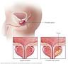 Prostate cancer - Symptoms and causes - Mayo Clinic