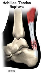 Recovery after an achilles tendon rupture. Achilles Tendonitis And Achilles Tendon Rupture Orthogate