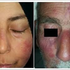 Because the skin is so sensitive, many things can cause rosacea to flare. Pdf Demodex An Eclectic Mite Living In Both Hair And Skin