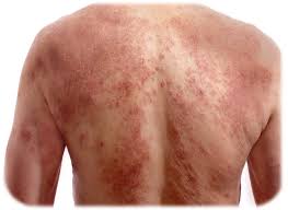 Image result for Atopic Dermatitis