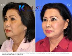 Brow lift surgery and facelift surgery can be tailored to help asian patients achieve a younger, more rested appearance. Asian Face Lift Before After Gallery Dr Kolstad San Diego Facial Plastic Surgeon