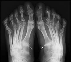 Rheumatoid arthritis is considered an indication for resurfacing of the patella during total knee arthroplasty. Sign Of The Metatarsophalangeal Instability Anteroposterior X Ray Of A Download Scientific Diagram
