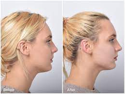 One side of face lifted higher than the others. What Should You Not Do After Pdo Thread Facelift Treatments Marina Medical Center