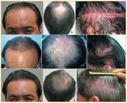 If scaling plaques are present on portions of the body in. Should Hair Transplantation Be Performed In Psoriasis Hair Transplant Forum International