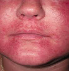 Image result for red rash face