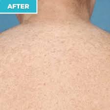 As the hair follicle dissipates you may remove the dead hairs before they fall out if you desire. Laser Hair Removal Laser Skin Solutions