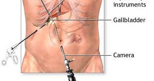 Gall Bladder Surgery Gallbladder Surgery After Gallbladder Surgery Gallbladder