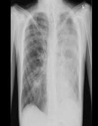Image result for Air Bronchogram
