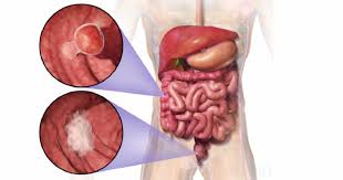 We did not find results for: Kanser Usus Punca Simptom Dan Rawatan Root Of Science