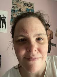 I have epilepsy, so my memory is not good between my seizures, the scar  tissue building