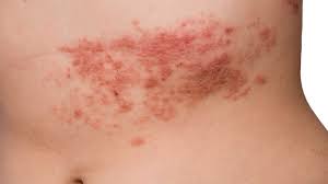 Skin Lesions Pictures Causes Types Risks Diagnosis And