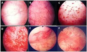 Image result for Interstitial Cystitis