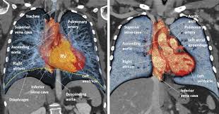We hope this picture chest bone, ribs, lung, heart, xiphoid process, sternum anatomy can help you study and research. 12 General Anatomy Of The Heart Radiology Key