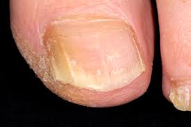 These sores may appear anywhere. Fungal Skin Infections Health Information Bupa Uk