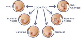 What are the symptoms, and how is it diagnosed and treated? The Silent Killer Inflammatory Breast Cancer Pictures And Early Detection Youmemindbody