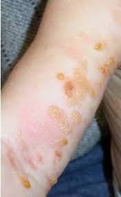 Image result for Urticaria pigmentosa children