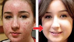 Sivilce Nasil Gecer Sivilcelere Evde Dogal Cozumler Cilt Bakimi Akne Tedavisi Cilt Bakimi Cilt Tedavileri