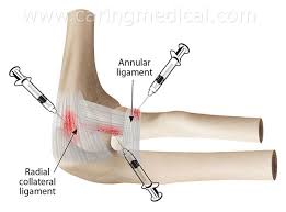 Protection from tennis elbow, golfers elbow & carpal tunnel. Tennis Elbow Pain Treatments Conservative Care Injections Surgery Caring Medical Florida