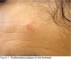 Image result for Diascopy