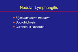 Image result for Nodular Lymphangitis