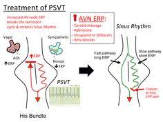 Pat stands for paroxysmal atrial (originating in the atria) tachycardia; Psvt
