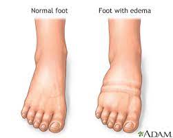 Foot, Leg, And Ankle Swelling: Medlineplus Medical Encyclopedia