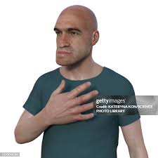 Image result for Acromegaly