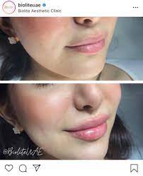 Qualified zip codes save big on insurance. How To Get Naturally Plump Lips
