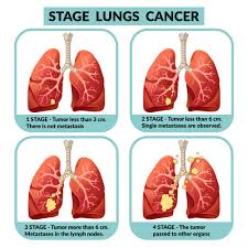 There are several stages of oncology. What Is The Best Treatment For Lung Cancer Stage 4 By Mayur Raval Cancercarenews Medium