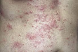 Image result for skin rash acute hiv infection
