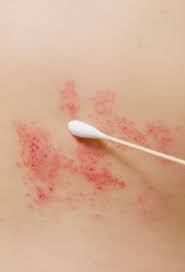 Image result for zoster under breasts