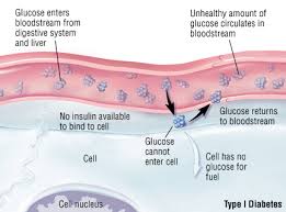 Type 1 Diabetes Mellitus Harvard Health