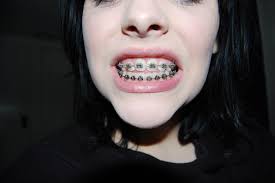 Metal detectors don't literally detect metal material but the magnetic field that metal produces. Bro News Archives Page 5 Of 6 Blue Ridge Orthodontics