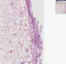 Vesicles deep in the cytoplasm in mesothelial cells were labeled for the . Histopathology Lung Pleura Mesothelioma Youtube