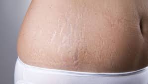 31 Black Seed Oil Fixes Stomach Stretch Marks Stretch Marks Damaged Skin