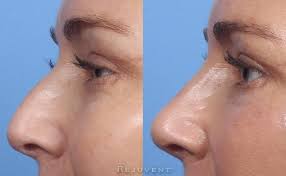 Natural Looking Liquid Rhinoplasty Results Nose Job Nose Rhinoplasty