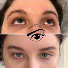 A wide variety of there are 43 suppliers who sells laser under eye circles on alibaba.com, mainly located in asia. Dark Circles Camouflage Brazilian Technique