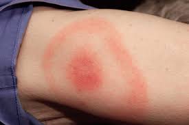 Image result for infected tick bite