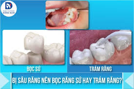 Bị sâu răng nên bọc răng sứ hay trám răng? - Nha Khoa Đông Nam®