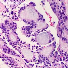 Start studying hkb pt 7. Woo Cheal Cho Md On Twitter Myxopapillary Ependymoma Filum Terminale Cauda Equina Neuropath Pathology Hhpath Hhpathology Beraad87 Sueepig Siddiquea Md Cruzjorgef Okhanmd Mishiepishi Easwarmd Safina8552 Berkalurk Therealbsym