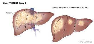 There is no cure for liver cancer. Liver Cancer In Children Causes Symptoms Diagnosis And Treatment St Louis Childrens Hospital