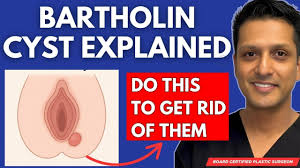 Image result for Bartholin's gland abscess