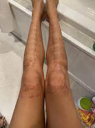 For example, the pulsed dye laser targets damaged blood vessels in your skin, reducing redness and inflammation by focusing on one small area at a time. Horrible Burns And Hypopigmentation After Laser Hair Removal Help Laser Hair Removal Hairtell Hair Removal Forum By Andrea James