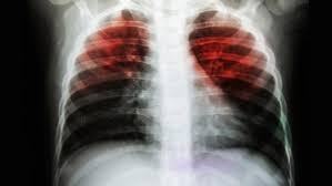 Tuberkuloz Verem Hastaligi Nedir Tuberkuloz Belirtileri Ve Tedavisi Saglik Son Dakika Haberler