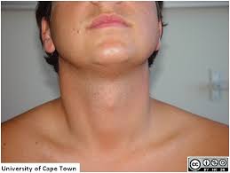 He said that i had a few slightly enlarged posterior cervical lymph nodes and they were probably due to a recent cold or virus. Clinical Skills Programme University Of Cape Town