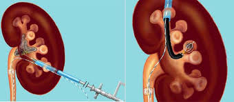 Kidney Stones Surgery Kidney Stones Removal Surgery Cost In India Medsurgeindia