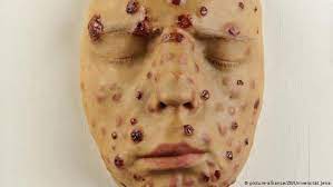 Gefahren Beim Sex Geschlechtskrankheit Syphilis Ist Zuruck Wissen Umwelt Dw 01 09 2018