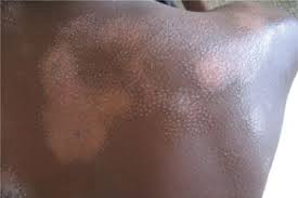 Image result for Postinflammatory Hypopigmentation