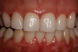 Gum Disease Pictures What Do Healthy Gums Look Like