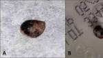  Boy, 11, has SEA SNAIL still in its shell removed from his elbow one week after falling on rocks at the beach